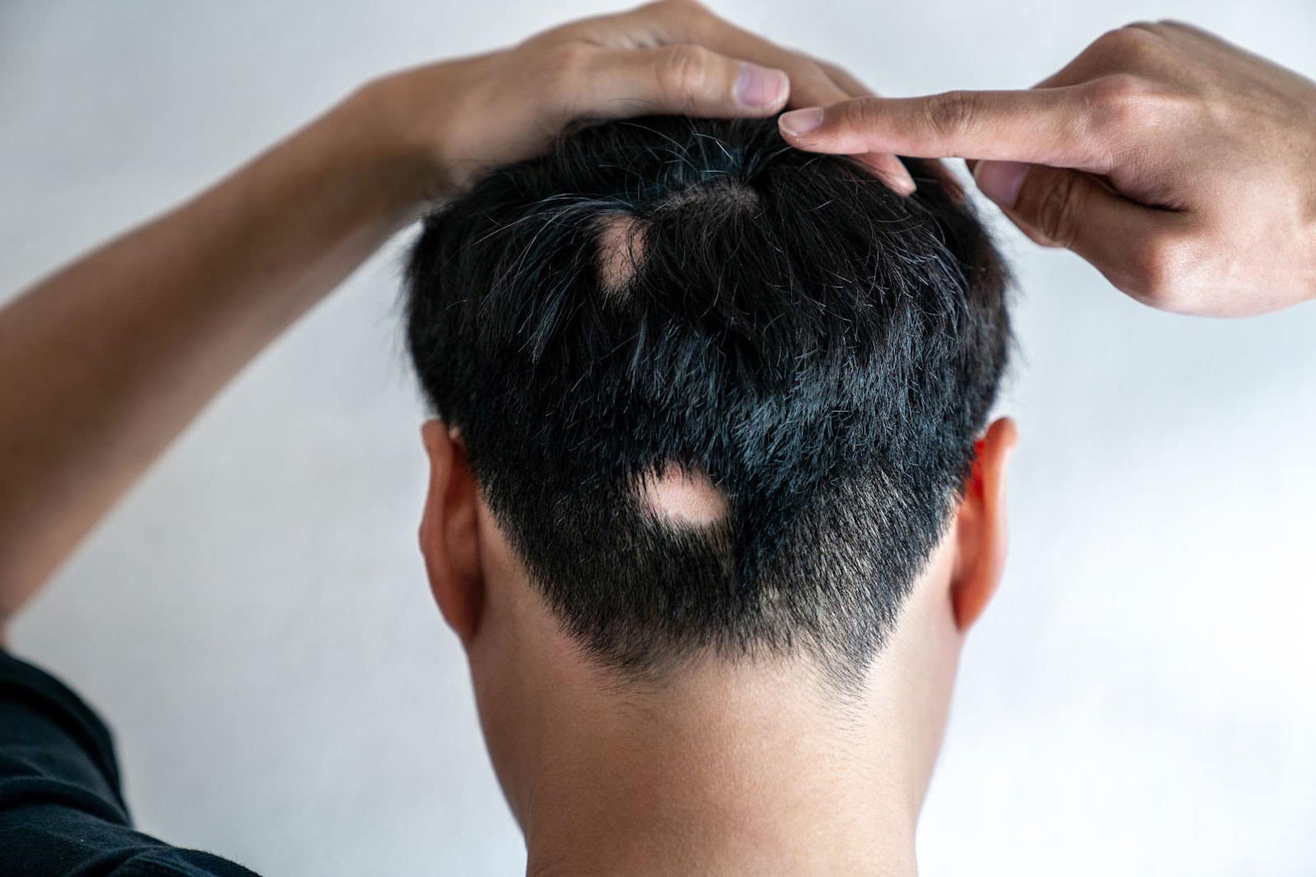 吳醫師也分享其中一宗難忘病例，患者為一名約20歲「斑禿」男生。（圖片：Shutterstock）