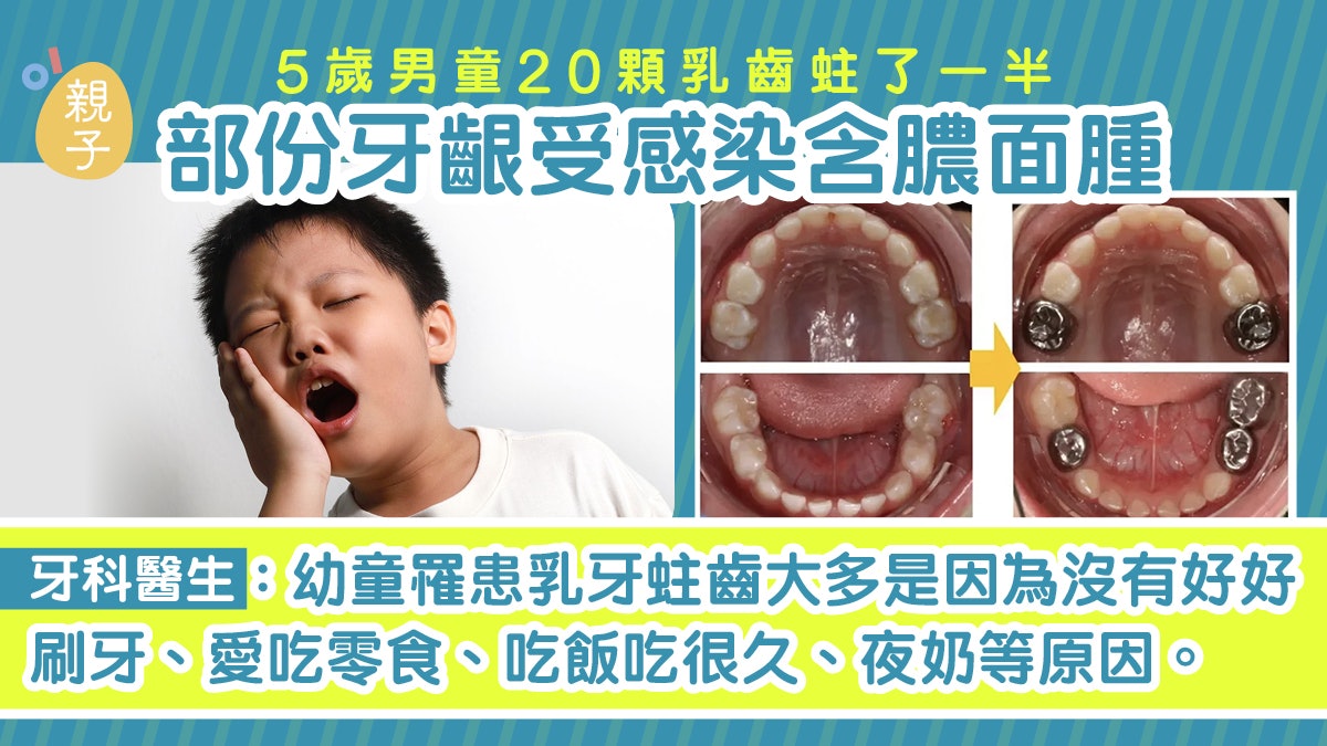蛀牙|5歲男童20顆乳齒蛀了一半 部份牙齦受感染 含膿含到面腫 蛀牙|5歲男童20顆乳齒蛀了一半 部份牙齦受感染 含膿含到面腫