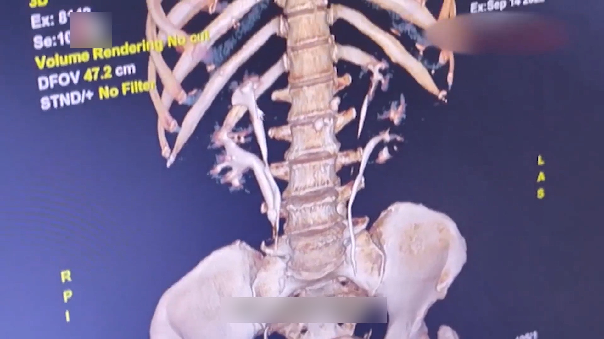 醫生做CT掃描後，發現吳女體內有4條輸尿管。（微博影片截圖）