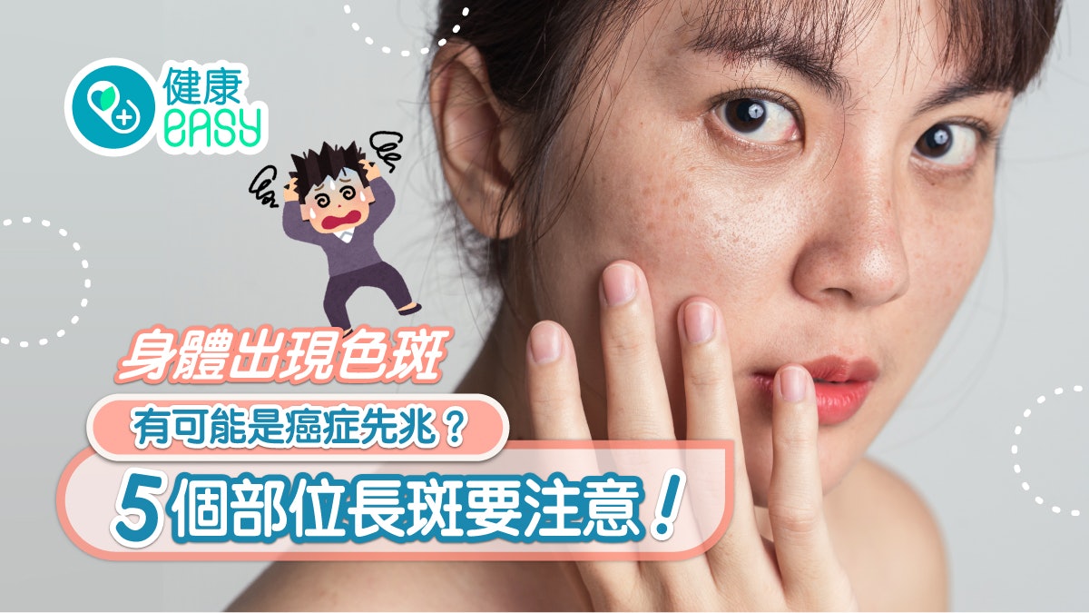 癌症|身體冒色斑是斑還是癌?5部位長斑要注意 記謹防曬ABC口訣 癌症|身體冒色斑是斑還是癌?5部位長斑要注意 記謹防曬ABC口訣
