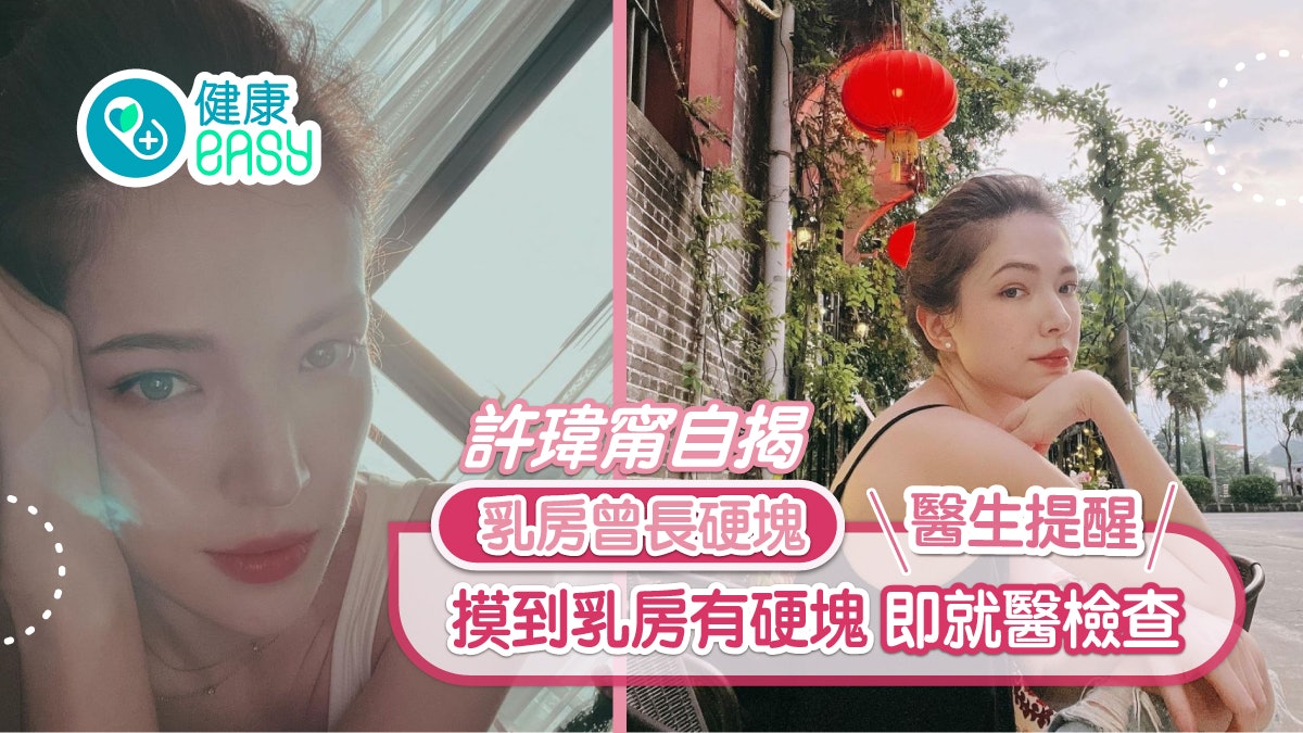 乳癌|許瑋甯自揭乳房曾長硬塊!醫提醒乳癌硬塊2徵兆即就醫檢查 乳癌|許瑋甯自揭乳房曾長硬塊!醫提醒乳癌硬塊2徵兆即就醫檢查