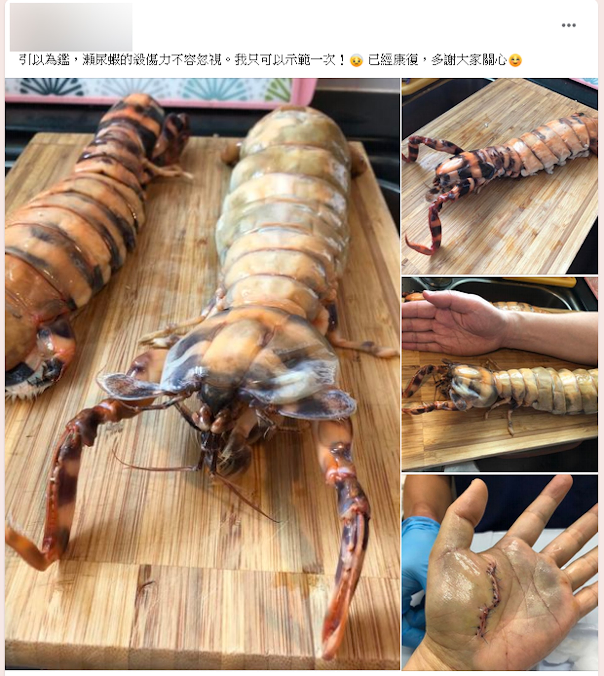 有網民在fb分享買瀨尿蝦後被擊傷的經歷,傷口很嚇人。(fb群組「香港街市魚類海鮮研究社」截圖) 有網民在fb分享買瀨尿蝦後被擊傷的經歷,傷口很嚇人。(fb群組「香港街市魚類海鮮研究社」截圖)