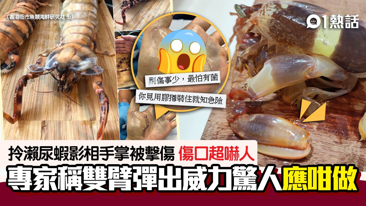 瀬尿蝦咁大力!男子拍打卡照被擊傷手留長疤痕 專家:一下爆手 瀬尿蝦咁大力!男子拍打卡照被擊傷手留長疤痕 專家:一下爆手