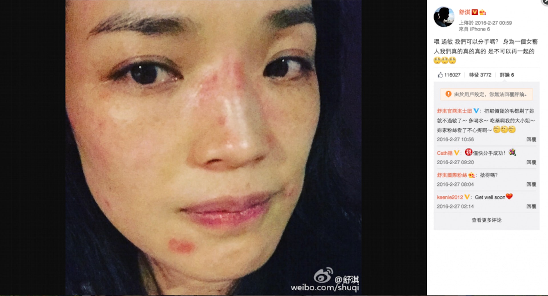 【濕疹原因|濕疹改善方法】轉季都會容易引起不少的皮膚問題,皮膚可能會出現敏感及濕疹等等(WEIBO@舒淇) 【濕疹原因|濕疹改善方法】轉季都會容易引起不少的皮膚問題,皮膚可能會出現敏感及濕疹等等(WEIBO@舒淇)
