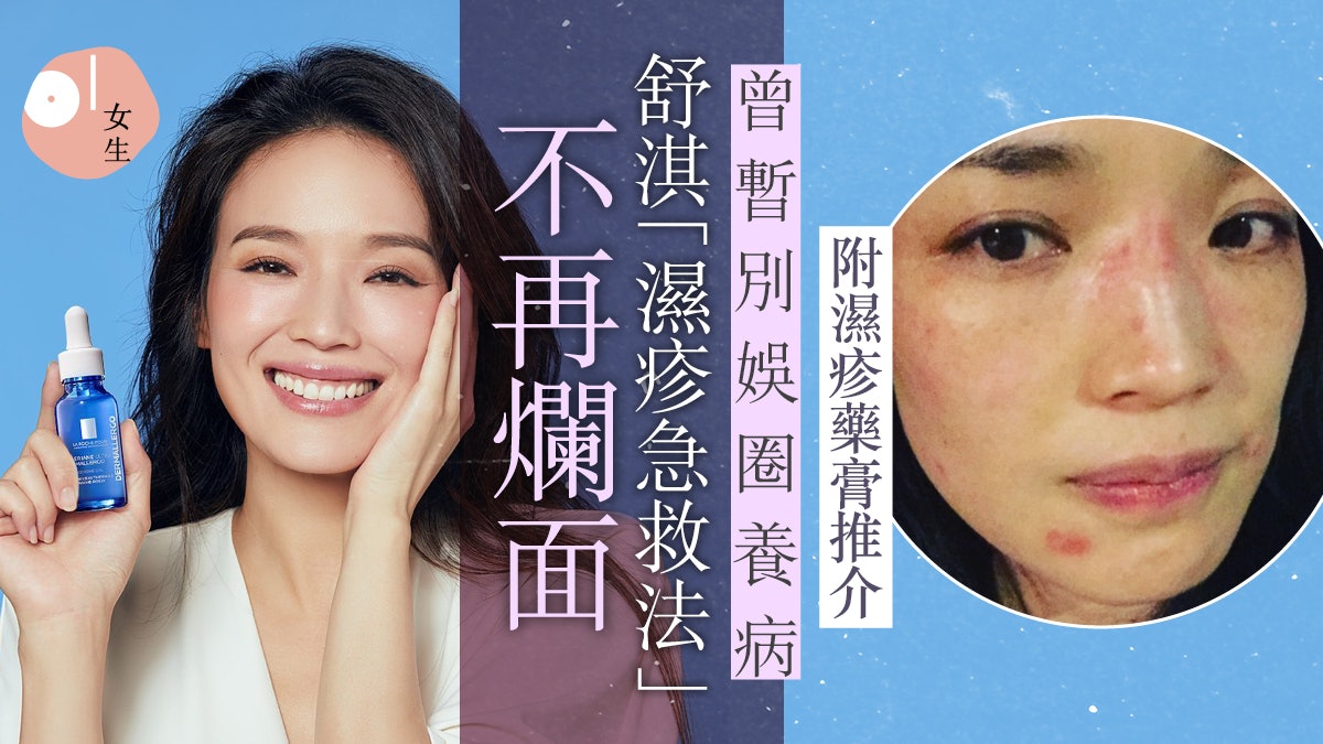 濕疹原因|舒淇曾受皮膚過敏而暫別娛圈養病 靠獨家偏方改善膚況 濕疹原因|舒淇曾受皮膚過敏而暫別娛圈養病 靠獨家偏方改善膚況