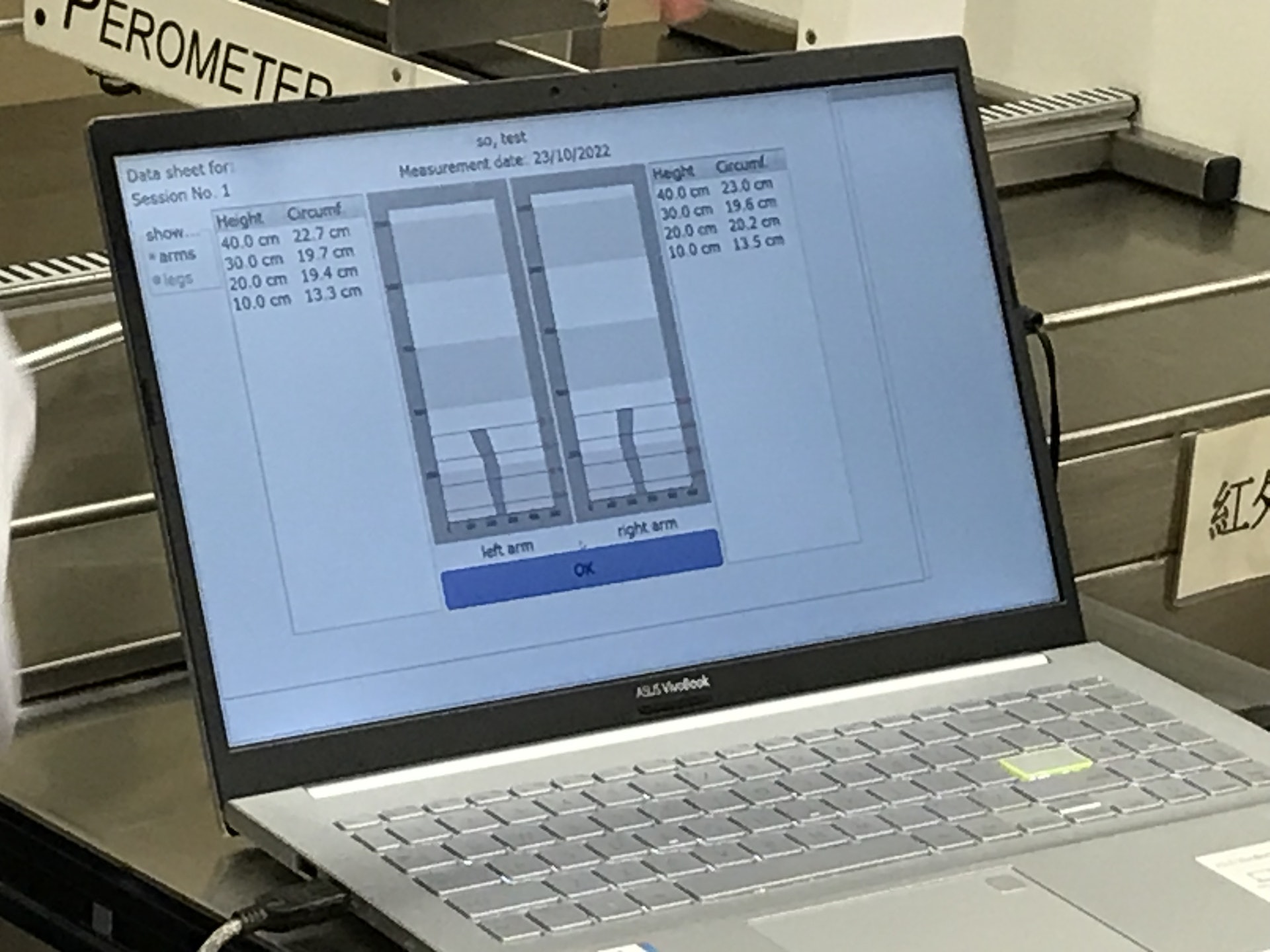 測量儀可透過電腦，即時看到病人手臂的尺寸數據，以檢查有否異常腫脹。(梁晉穎攝)