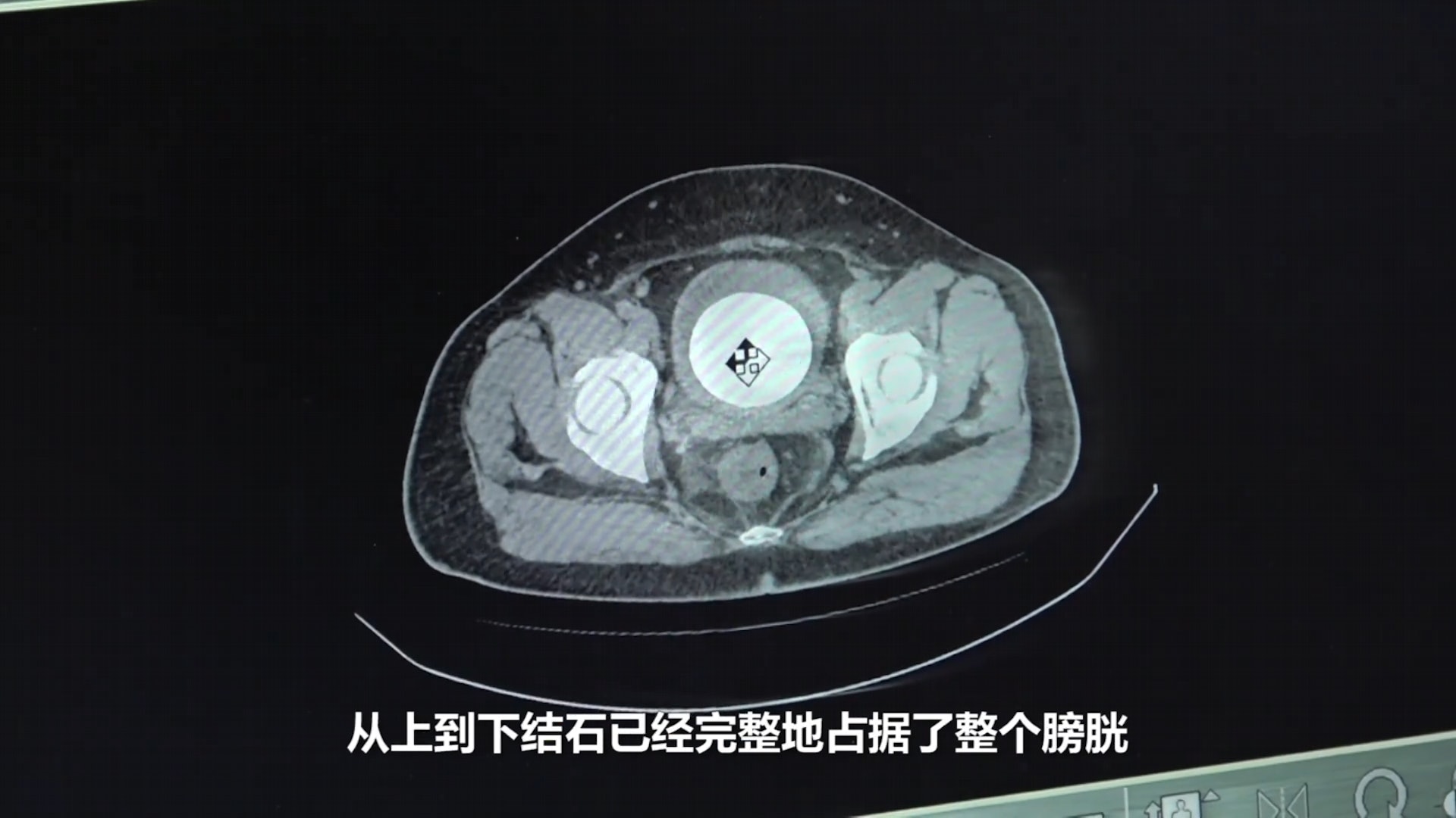 該男子腹中結石已幾乎佔滿整個膀胱。（荔枝視頻）