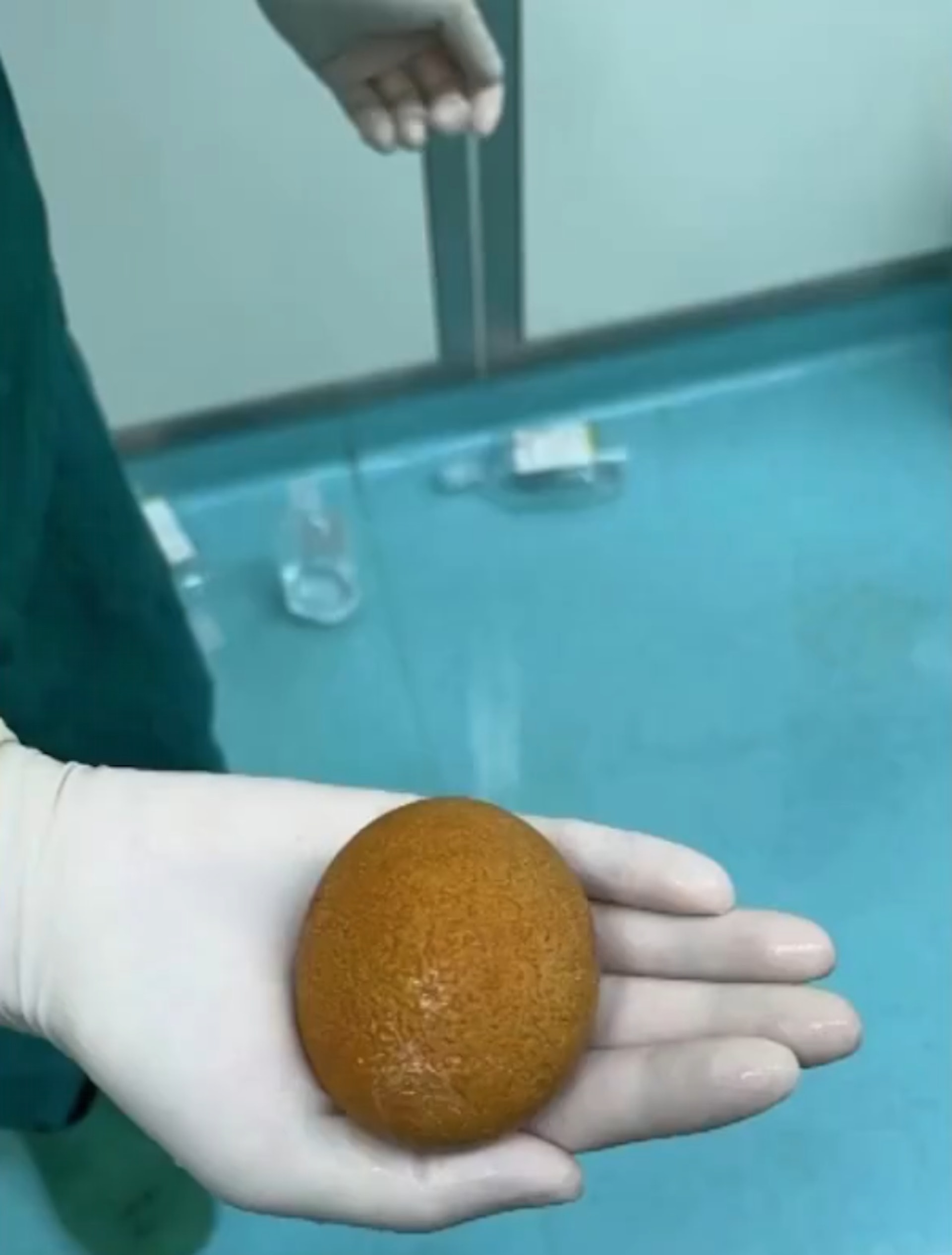 該男子腹中結石已幾乎佔滿整個膀胱。(荔枝視頻) 該男子腹中結石已幾乎佔滿整個膀胱。(荔枝視頻)