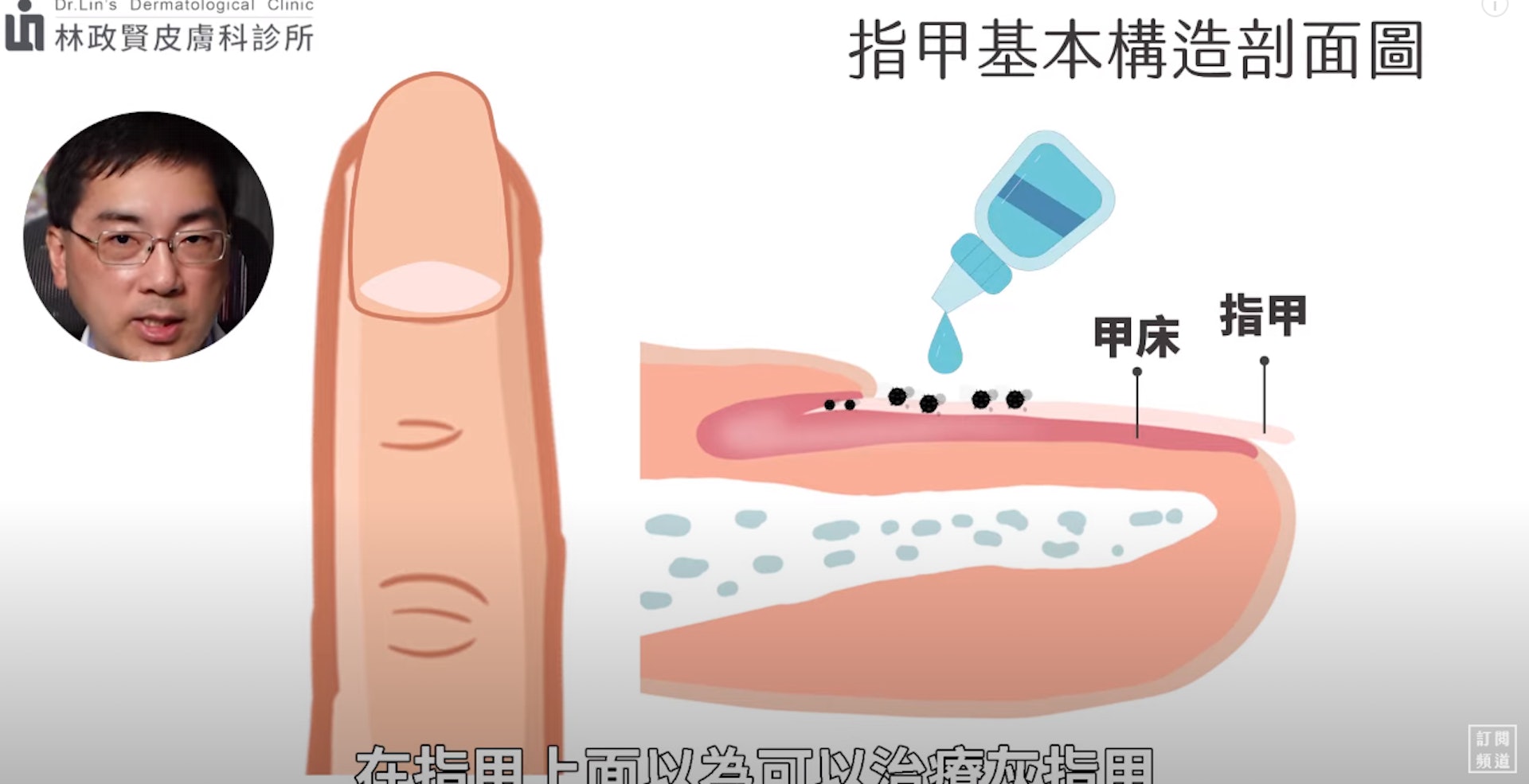 灰甲｜穿錯鞋恐引發成灰甲（Youtube@林政賢皮膚科診所）