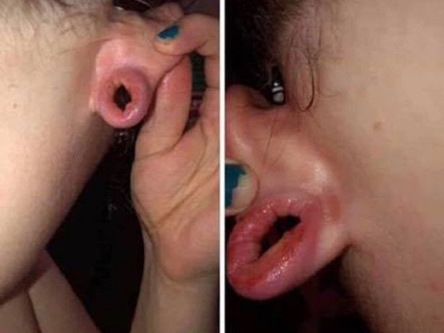 女事主在facebook上傳照片，稱男友在親熱時提出要將陰莖穿過她的耳洞，結果令她耳垂部位發炎。（網上圖片）
