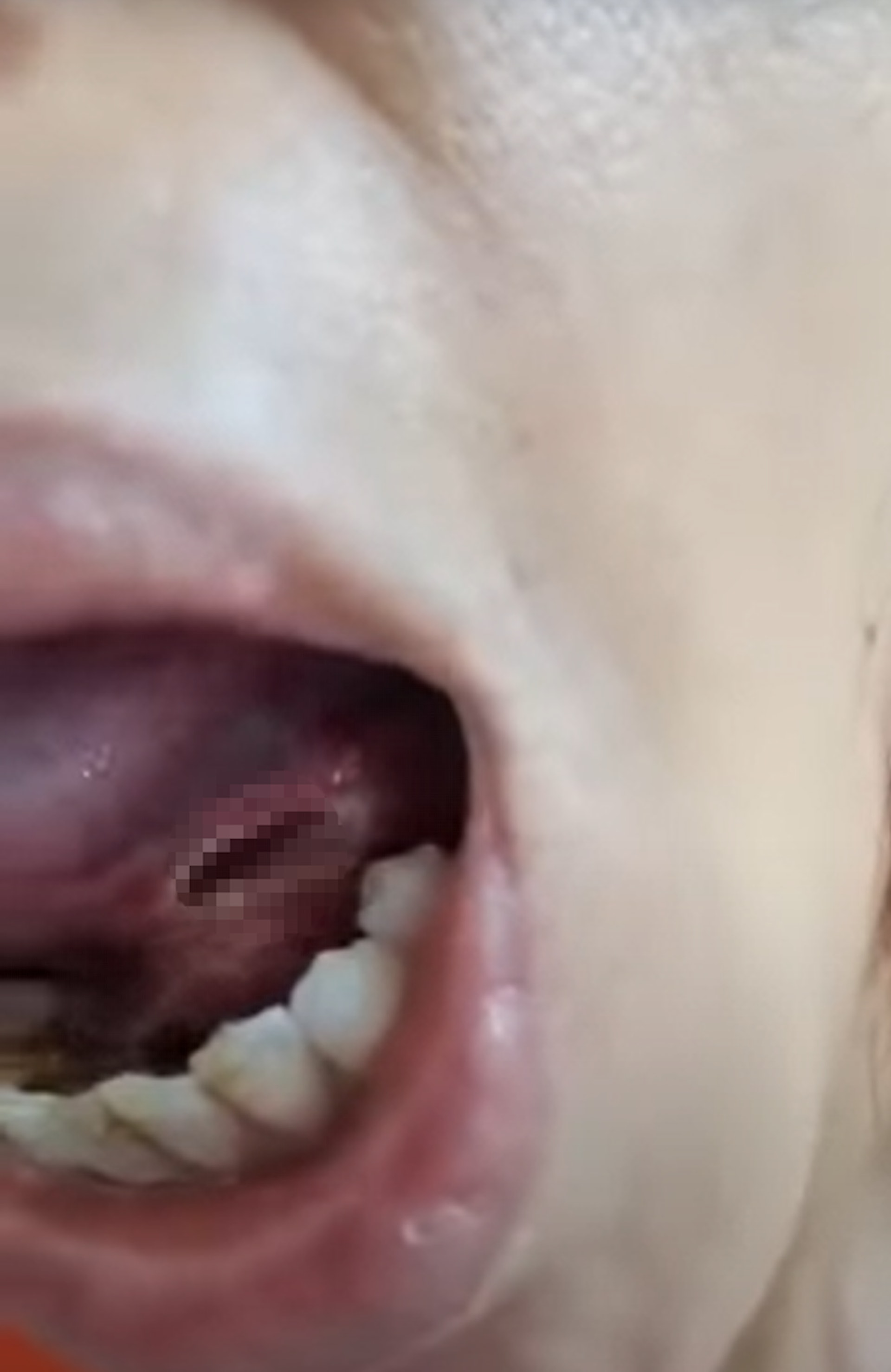 台女指早前到牙醫診所拔牙，待麻醉藥消退後，發現舌頭下竟穿了一個大洞，傷口深到「棉花棒都可插到底」，怎料牙醫竟表示「破皮而已」。（FB「爆料公社」影片截圖）