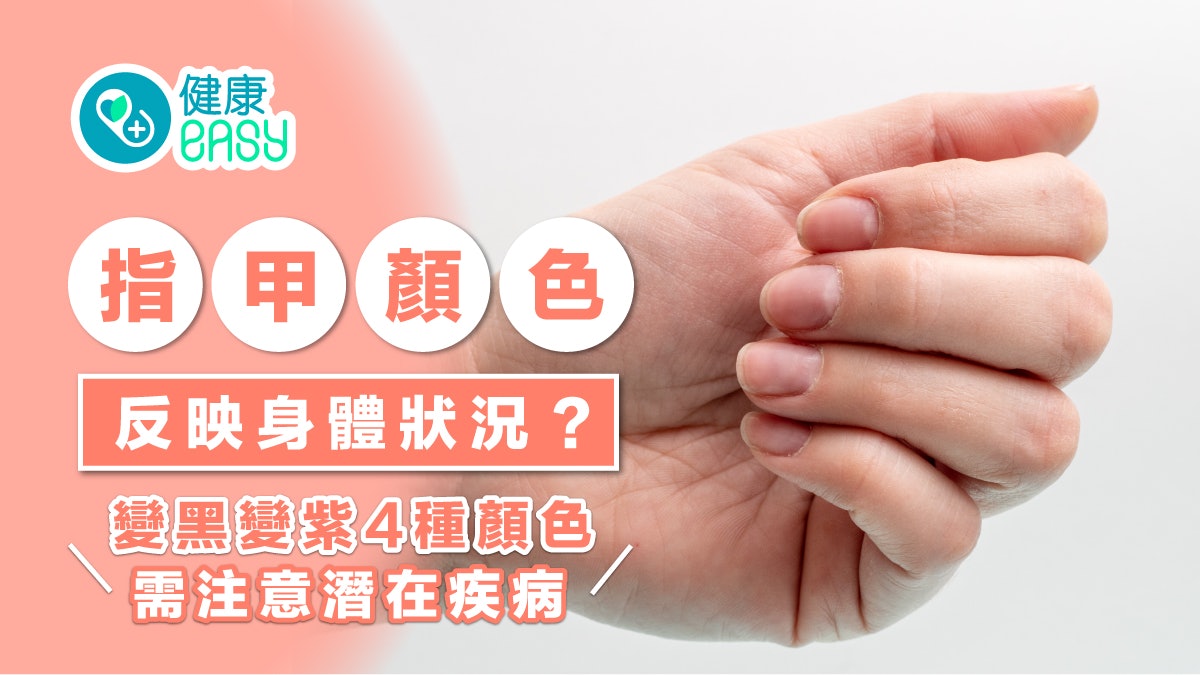 指甲|指甲顏色反映身體狀況?變黑變紫4種顏色需注意潛在疾病 指甲|指甲顏色反映身體狀況?變黑變紫4種顏色需注意潛在疾病
