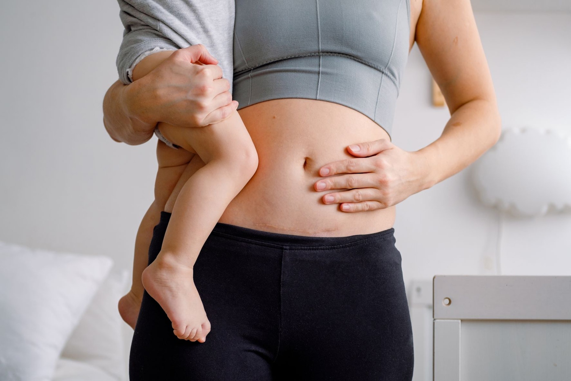 接受剖腹產、腹部手術、子宮或附件切除的病人,在術後盡快處理疤痕能減低粘連增生的情況。(圖片:Shutterstock) 接受剖腹產、腹部手術、子宮或附件切除的病人,在術後盡快處理疤痕能減低粘連增生的情況。(圖片:Shutterstock)