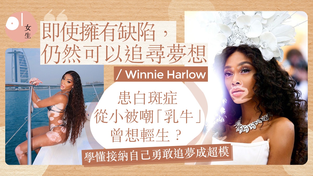 白斑症超模從小被欺凌曾欲輕生 走出低谷勇敢追夢:自信就是美 白斑症超模從小被欺凌曾欲輕生 走出低谷勇敢追夢:自信就是美