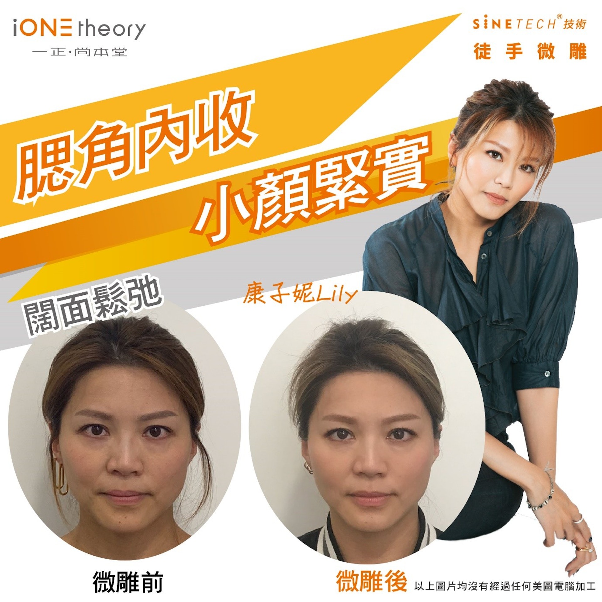 藝人康子妮經常給人感覺憔悴無神;嘗試SINETECH®「徒手微雕」後效果十分理想。透過顴骨和腮骨整復技術以收窄全面,面部看起來容光煥發,年輕逆齡。(圖片: iONE theory) 藝人康子妮經常給人感覺憔悴無神;嘗試SINETECH®「徒手微雕」後效果十分理想。透過顴骨和腮骨整復技術以收窄全面,面部看起來容光煥發,年輕逆齡。(圖片: iONE theory)