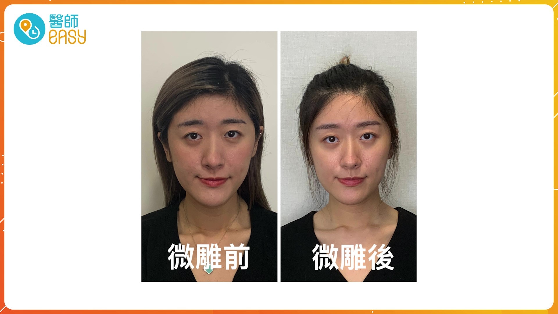 Gigi本身有「基因型大細面」,透過採用顴骨、鼻骨、腮骨的無痛啪骨整復技術,成功將她面部向中間收窄接近2公分,看起來比例更集中。(圖片:醫師Easy製圖) Gigi本身有「基因型大細面」,透過採用顴骨、鼻骨、腮骨的無痛啪骨整復技術,成功將她面部向中間收窄接近2公分,看起來比例更集中。(圖片:醫師Easy製圖)