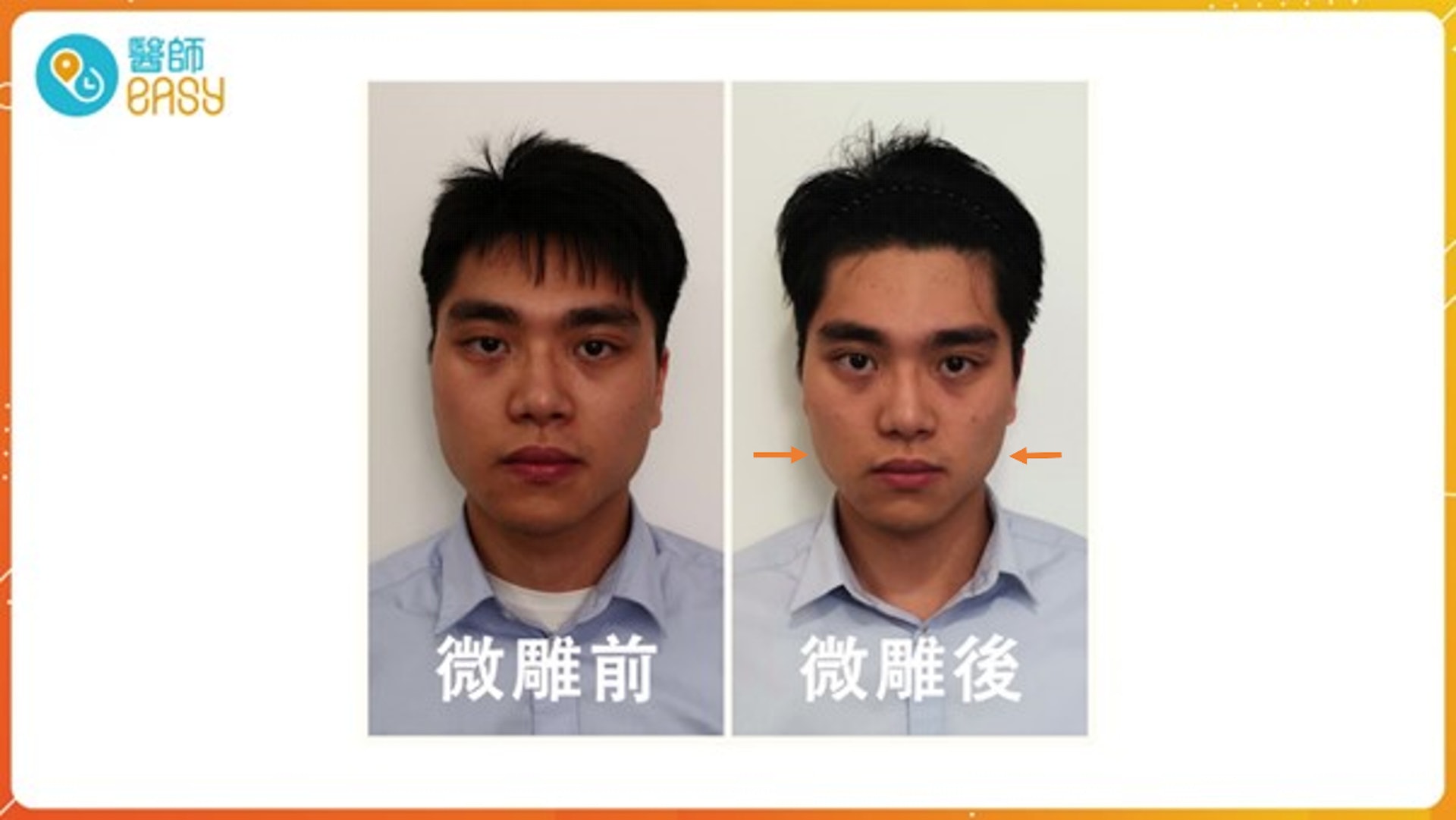 Felix的面部由梯形,成功轉變為倒三角形;看起來更加精神,而且有少許「小鮮肉」的感覺。(圖片:醫師Easy製圖) Felix的面部由梯形,成功轉變為倒三角形;看起來更加精神,而且有少許「小鮮肉」的感覺。(圖片:醫師Easy製圖)