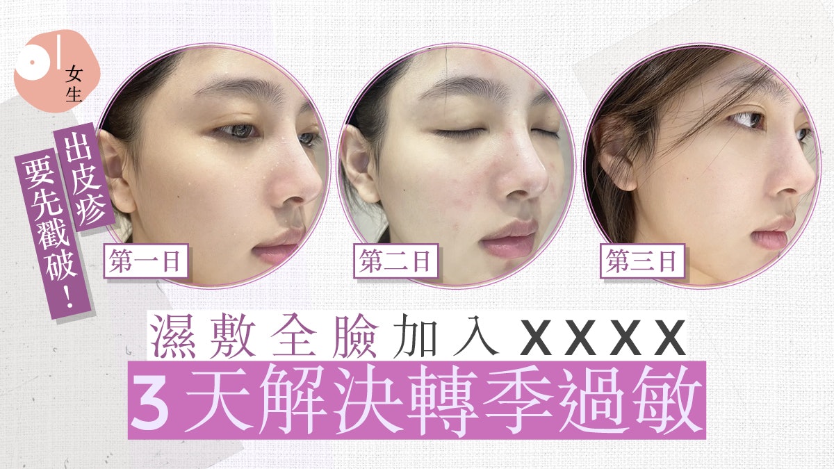 敏感肌轉季必看!只需3日肌膚回復白滑同步解決皮疹、過敏泛紅 敏感肌轉季必看!只需3日肌膚回復白滑同步解決皮疹、過敏泛紅