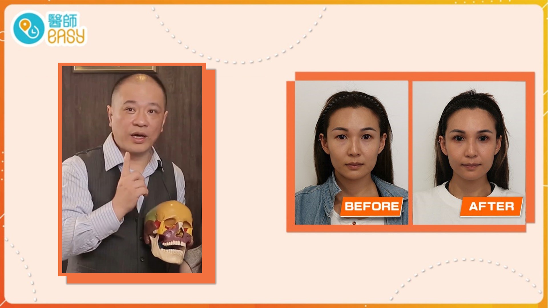 陳教授表示面骨是有活動力的,無需開刀、打針也可改善面型。 陳教授表示面骨是有活動力的,無需開刀、打針也可改善面型。