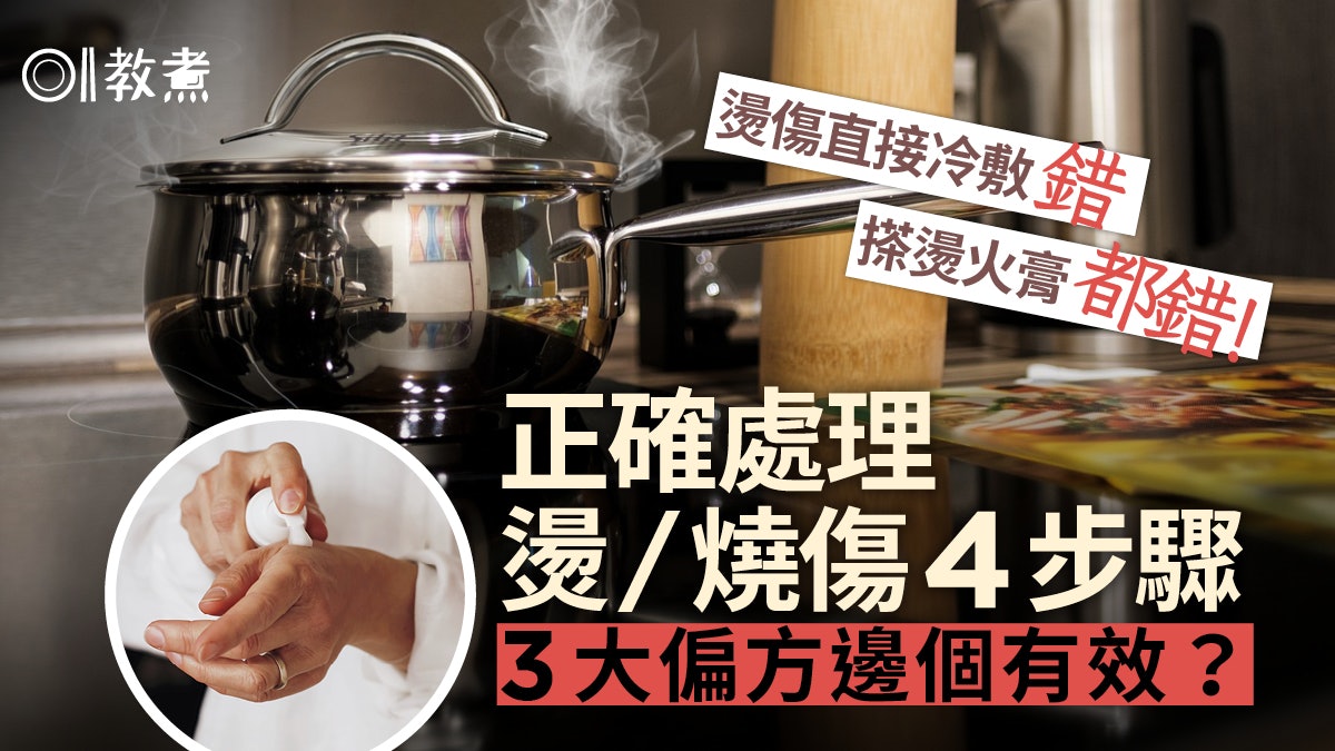 燙傷急救|冰敷更傷?搽燙火膏都錯?正確處理4步驟3偏方哪樣有效 燙傷急救|冰敷更傷?搽燙火膏都錯?正確處理4步驟3偏方哪樣有效
