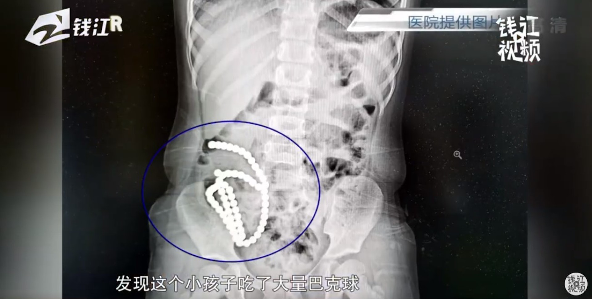 浙江嘉興市4歲女童誤吞了俗稱「巴克球」的磁力珠，造成14處胃腸道穿孔。（《錢江視頻》微博影片截圖）