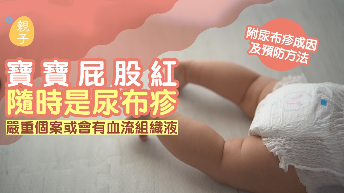 尿布疹|寶寶屁股紅隨時是尿布疹 嚴重個案或會有血流組織液 尿布疹|寶寶屁股紅隨時是尿布疹 嚴重個案或會有血流組織液