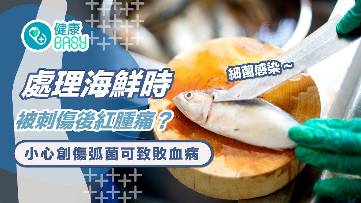 細菌感染｜處理海鮮時被刺傷後紅腫痛？小心創傷弧菌可致敗血病