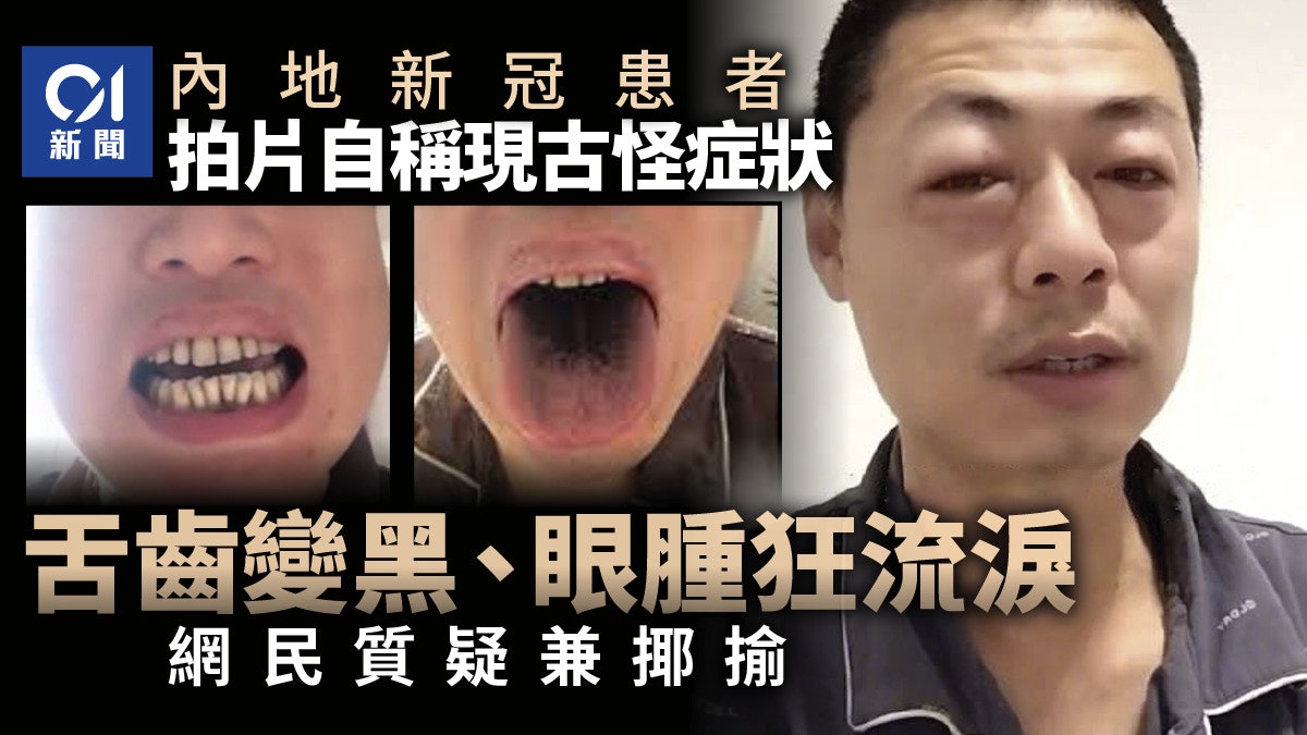 內地新冠患者古怪症狀曝光 舌齒全變黑 狂流淚雙眼腫如鹹蛋超人 內地新冠患者古怪症狀曝光 舌齒全變黑 狂流淚雙眼腫如鹹蛋超人