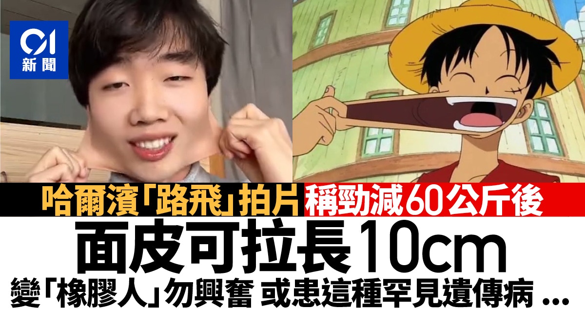 減肥狂甩60公斤後驚變「橡膠人」　臉皮能拉10cm　或患遺傳病？