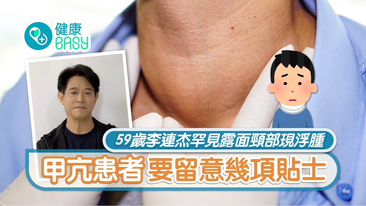 甲亢 | 59歲李連杰罕見露面頸部現浮腫 甲亢患者要留意幾項貼士 甲亢 | 59歲李連杰罕見露面頸部現浮腫 甲亢患者要留意幾項貼士