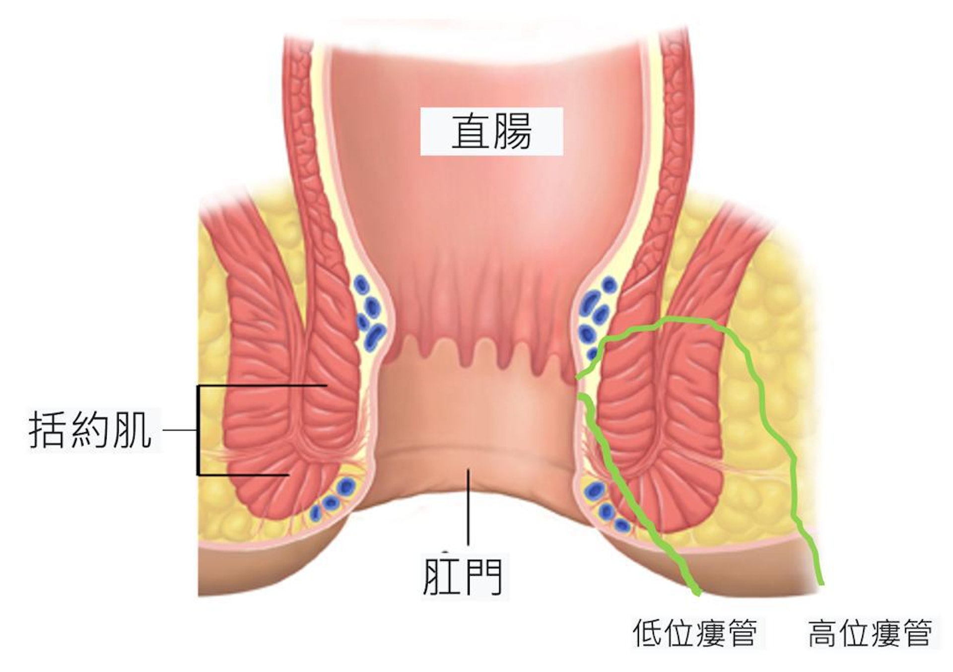 本地8至9成的肛門瘻管個案由肛門腺體發炎引起,男性個案超過一半。 本地8至9成的肛門瘻管個案由肛門腺體發炎引起,男性個案超過一半。