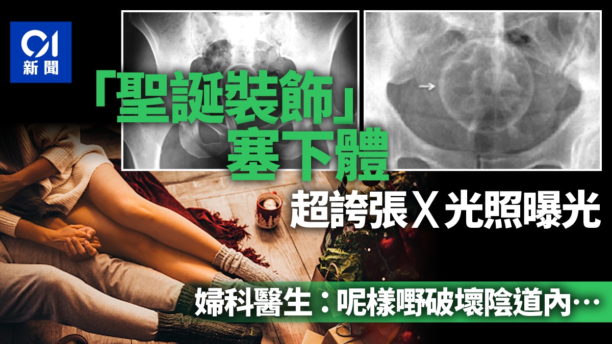 英國女求醫下體離奇出現「聖誕裝飾」　誇張X光照令婦科醫生看呆