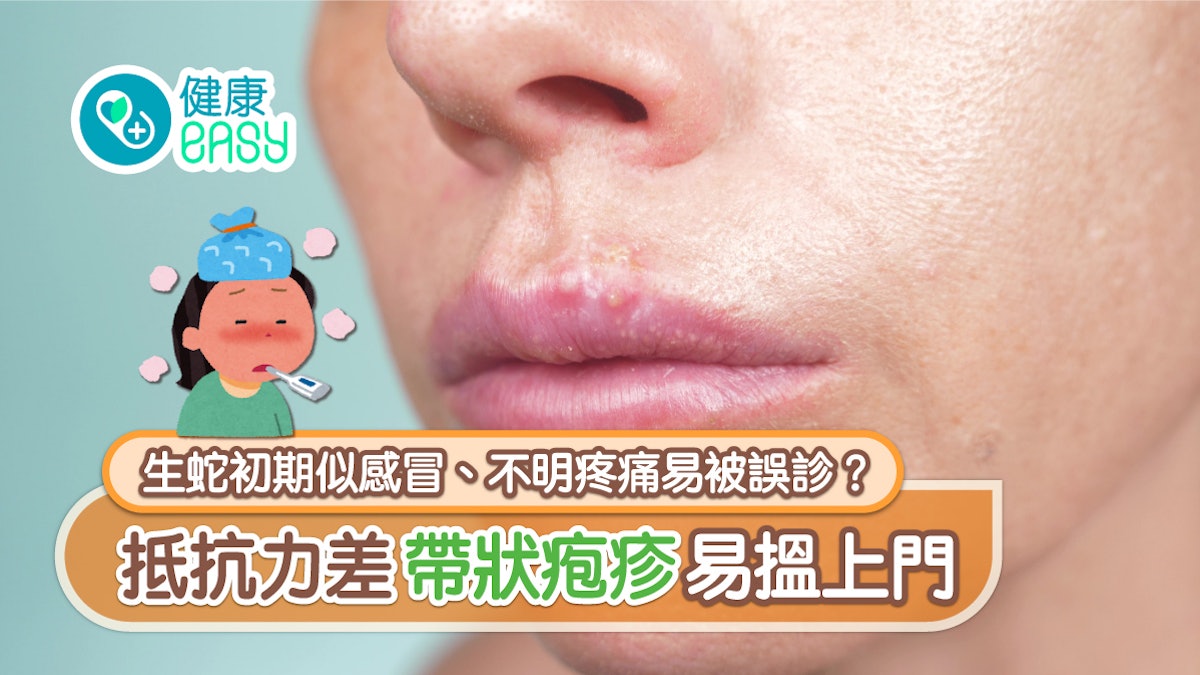 生蛇|初期似感冒、不明疼痛易被誤診?抵抗力差帶狀疱疹易搵上門 生蛇|初期似感冒、不明疼痛易被誤診?抵抗力差帶狀疱疹易搵上門