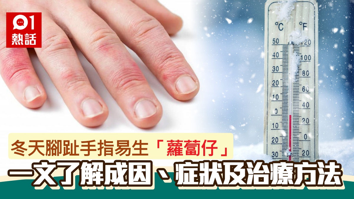 凍瘡|女性較男性更易生「蘿蔔仔」 一文睇清症狀及治療方法 凍瘡|女性較男性更易生「蘿蔔仔」 一文睇清症狀及治療方法
