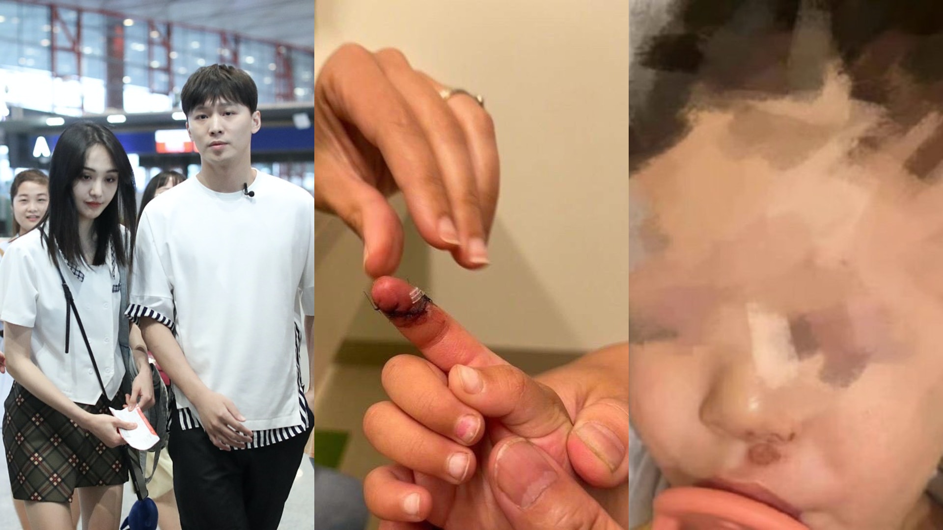 鄭爽被前男友張恆公開控訴虐童 女兒手指現6cm傷口觸目驚心 鄭爽被前男友張恆公開控訴虐童 女兒手指現6cm傷口觸目驚心