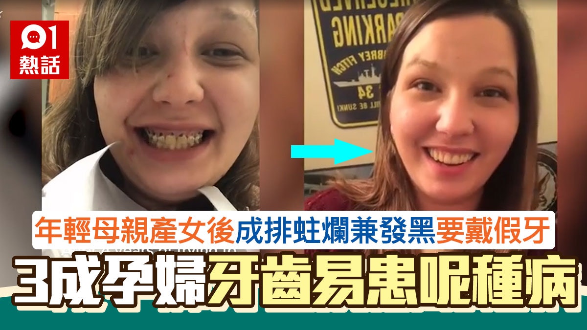 90後媽媽懷孕後全排牙蛀爛發黑 無悔用「微笑」換女兒感動網民 90後媽媽懷孕後全排牙蛀爛發黑 無悔用「微笑」換女兒感動網民