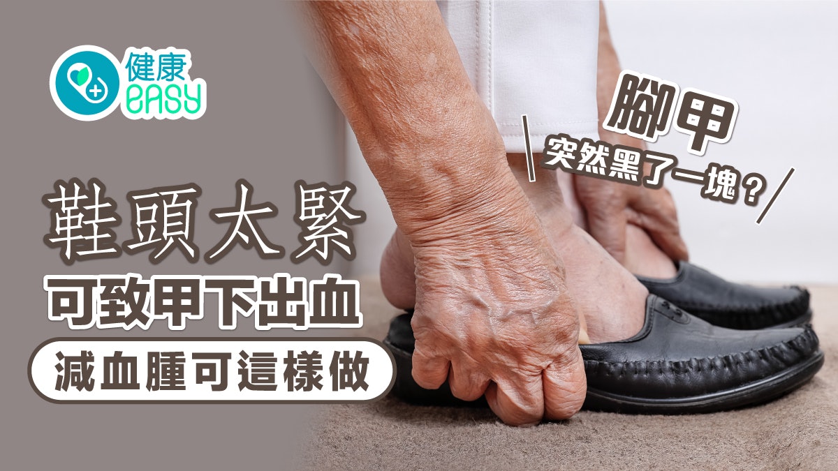 指甲|腳甲突然黑了一塊?鞋頭太緊可致甲下出血 減血腫可這樣做 指甲|腳甲突然黑了一塊?鞋頭太緊可致甲下出血 減血腫可這樣做