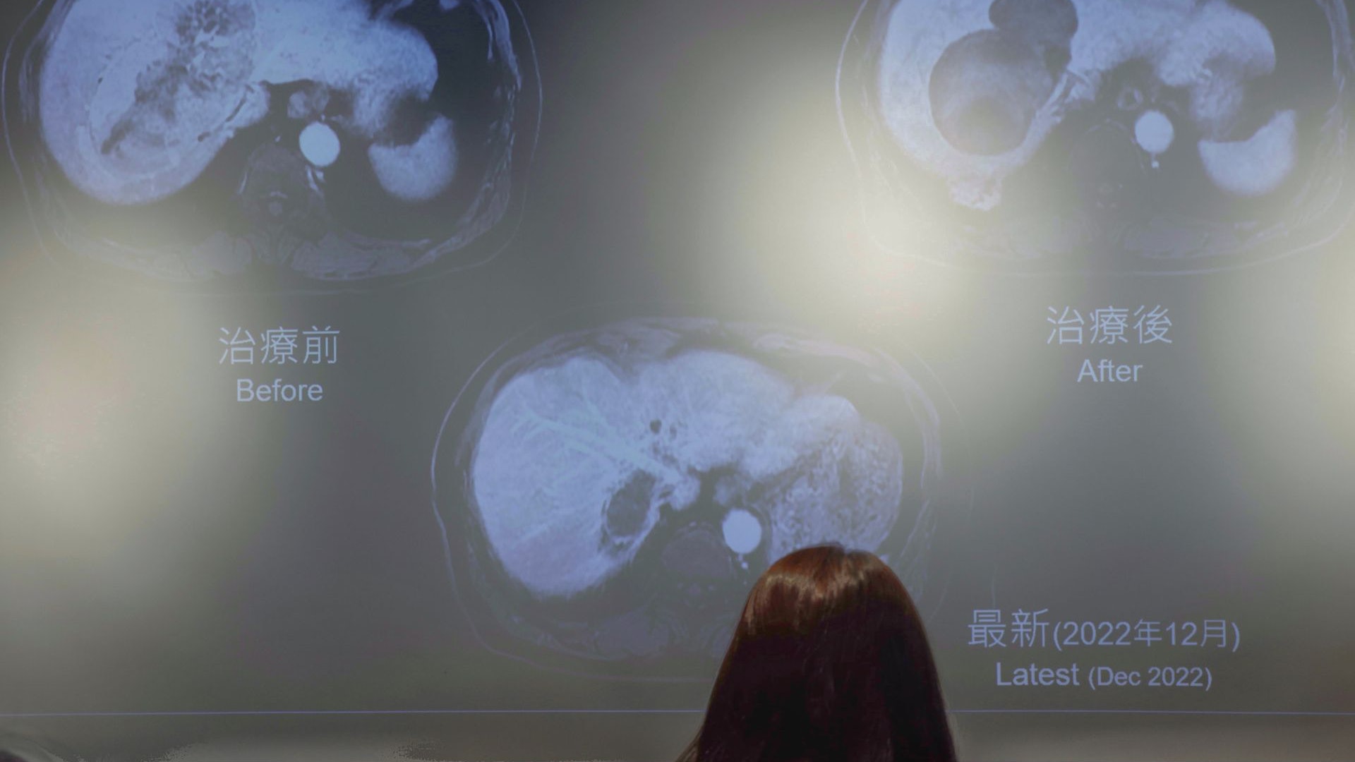 港大創「先縮後除」肝癌療法 存活率逾九成 免疫治療約廿萬元 港大創「先縮後除」肝癌療法 存活率逾九成 免疫治療約廿萬元
