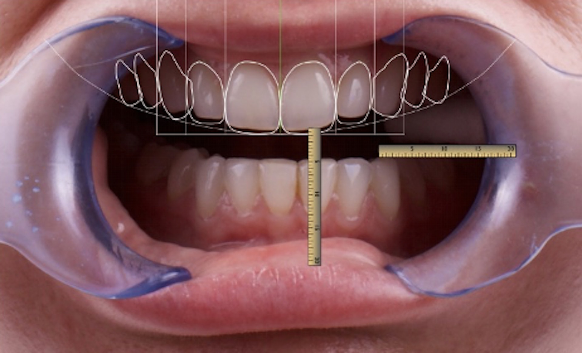 牙齒貼片療程主流做法是配合數碼笑容設計 (Digital Smile Design) 的電腦軟件程式技術收集個人的口腔、臉型、笑容、臉部表情等數據。（圖片：THP Dental）