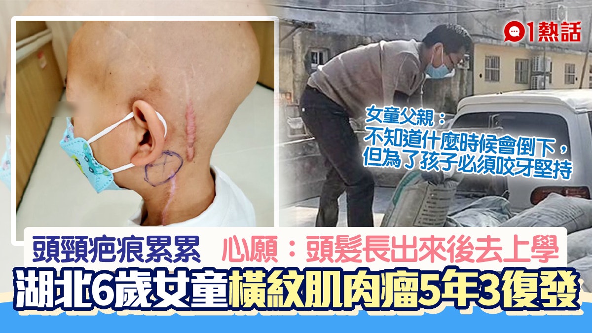 催淚!6歲女童患惡性腫瘤5年3度復發 母痛哭:整個童年都在醫院 催淚!6歲女童患惡性腫瘤5年3度復發 母痛哭:整個童年都在醫院