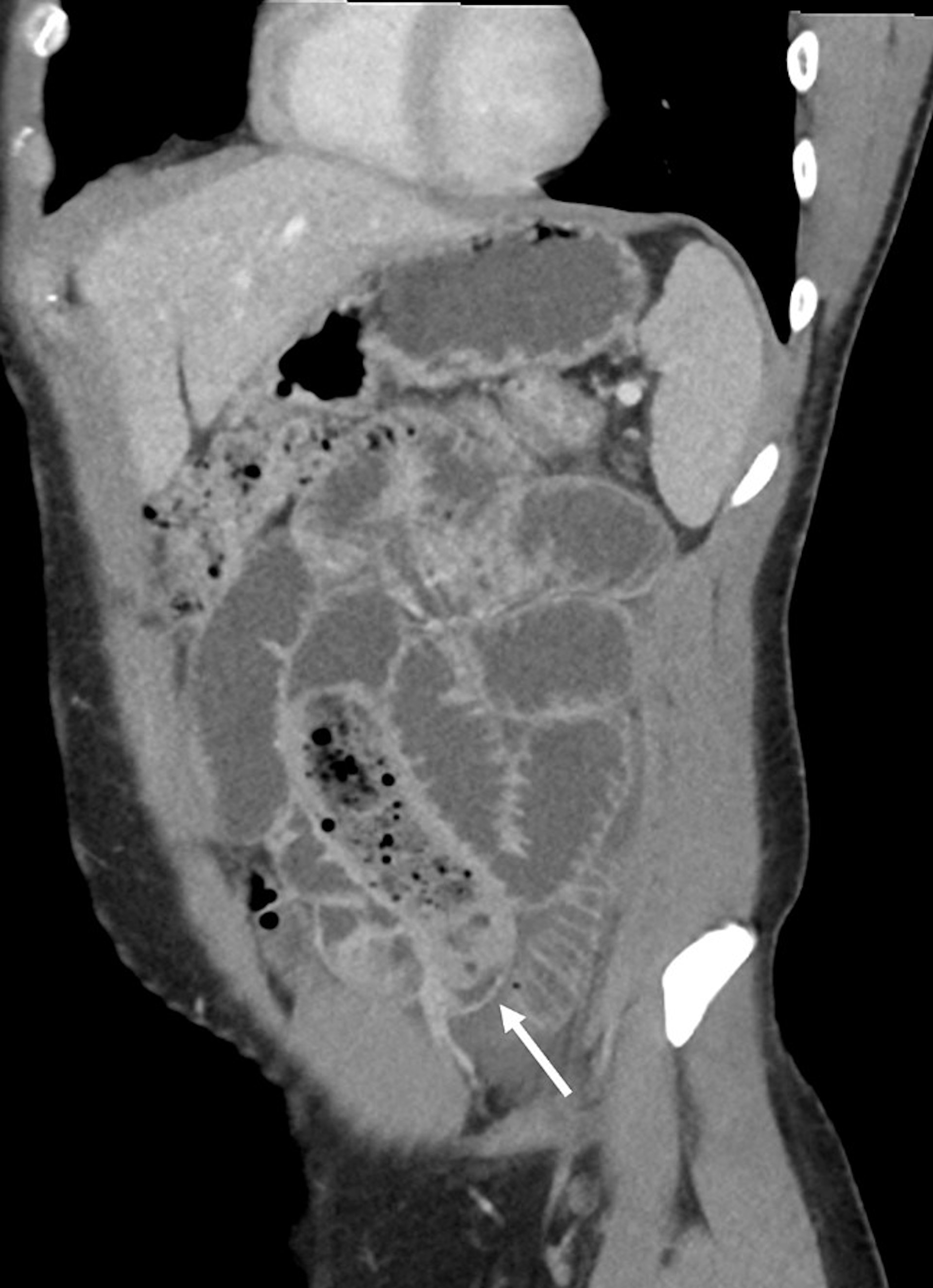 美國1名34歲男子因荷爾蒙引致情緒失衡,吞下「用安全套包裹的香蕉」,最終導致小腸梗阻。(「Cureus」圖片)