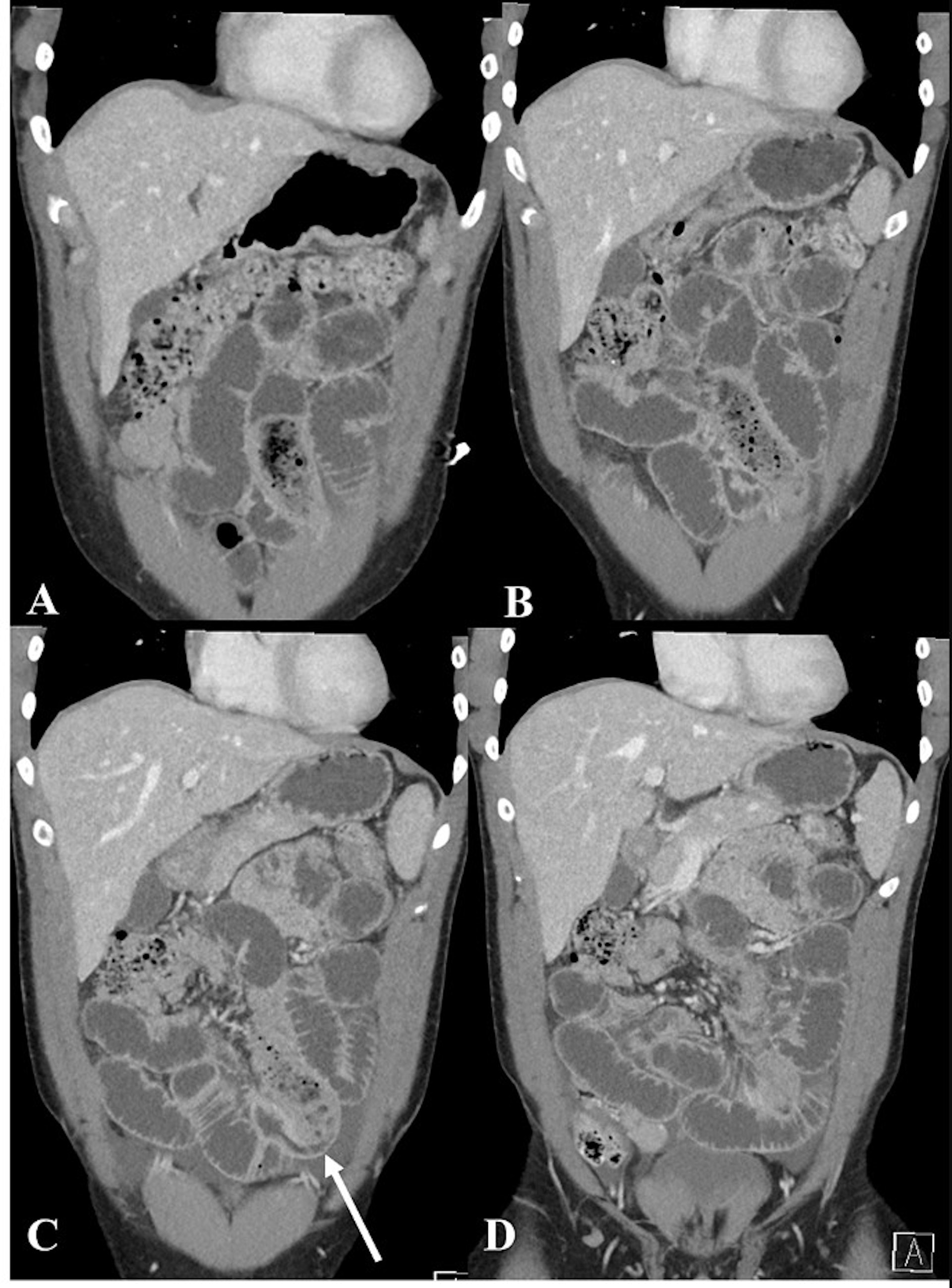 醫生為男子進行電腦斷層掃瞄,顯示他的腸內有明顯的長條狀異物。(「Cureus」圖片)