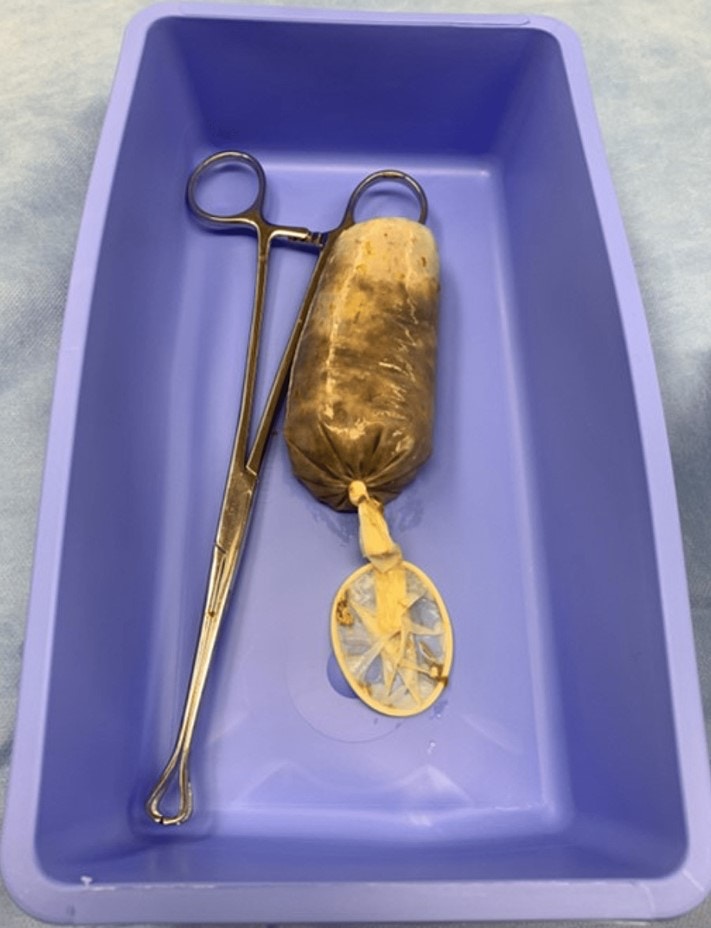 從照片可見,香蕉已經發黑軟爛滲液,而安全套被打了結因此內容物沒有流出。(「Cureus」圖片)