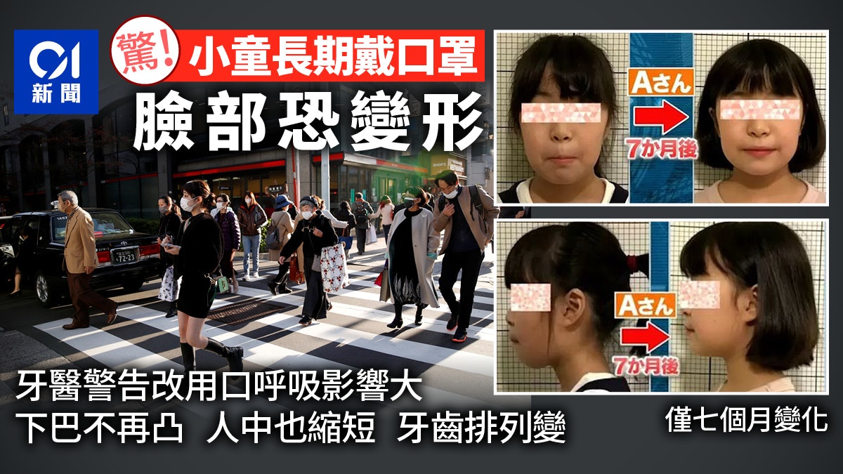 長期戴口罩或影響小童發育 牙醫揭恐怖結果:肌肉塌陷臉變長 長期戴口罩或影響小童發育 牙醫揭恐怖結果:肌肉塌陷臉變長