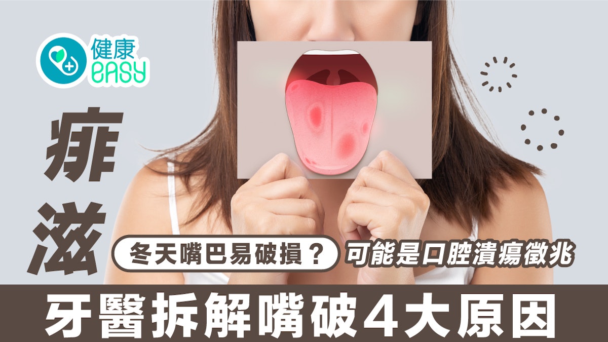 痱滋|冬天嘴巴易破損?可能是口腔潰瘍徵兆 牙醫拆解嘴破4大原因 痱滋|冬天嘴巴易破損?可能是口腔潰瘍徵兆 牙醫拆解嘴破4大原因