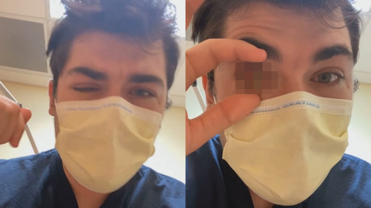 【有圖慎入】男子戴隱形眼鏡睡着 遭食肉菌「啃食眼角膜」或失明 【有圖慎入】男子戴隱形眼鏡睡着 遭食肉菌「啃食眼角膜」或失明