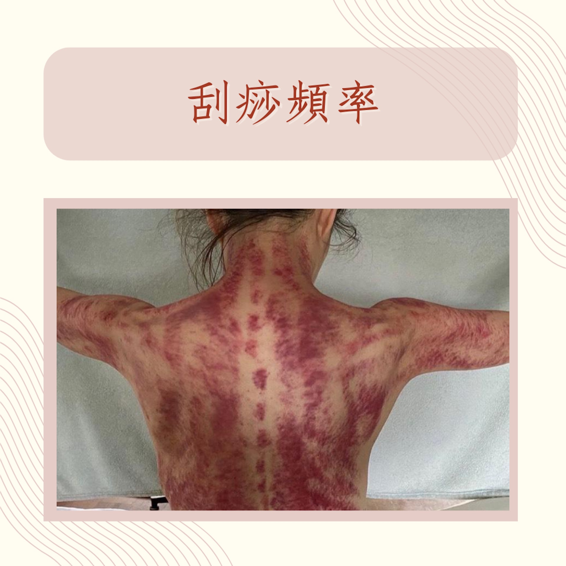 刮痧3大注意事項(IG@sammi_chengsauman;01製圖) 刮痧3大注意事項(IG@sammi_chengsauman;01製圖)