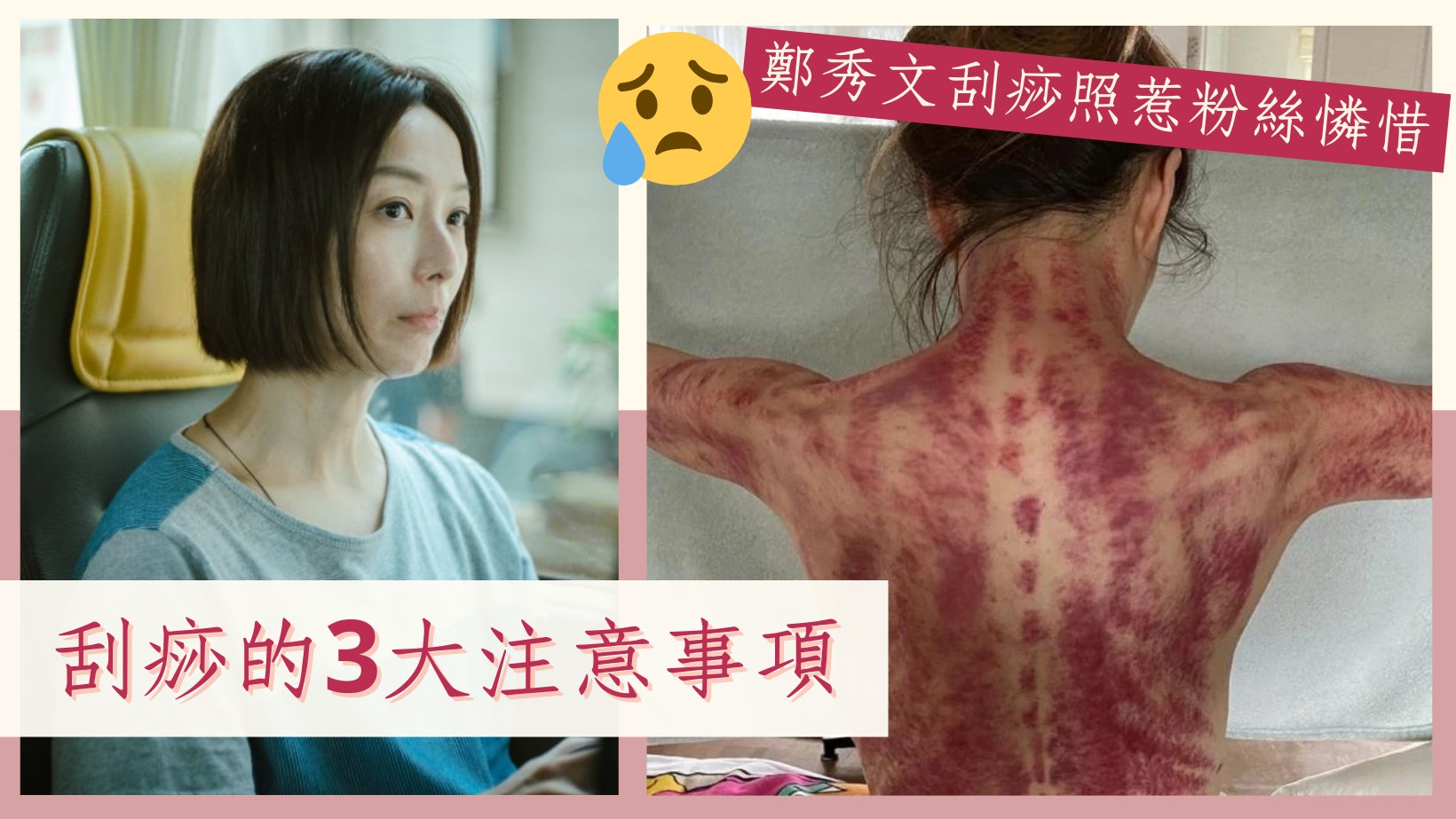 通氣血|鄭秀文刮痧照嚇壞粉絲!治療頻率、刮後飲食及注意事項 通氣血|鄭秀文刮痧照嚇壞粉絲!治療頻率、刮後飲食及注意事項