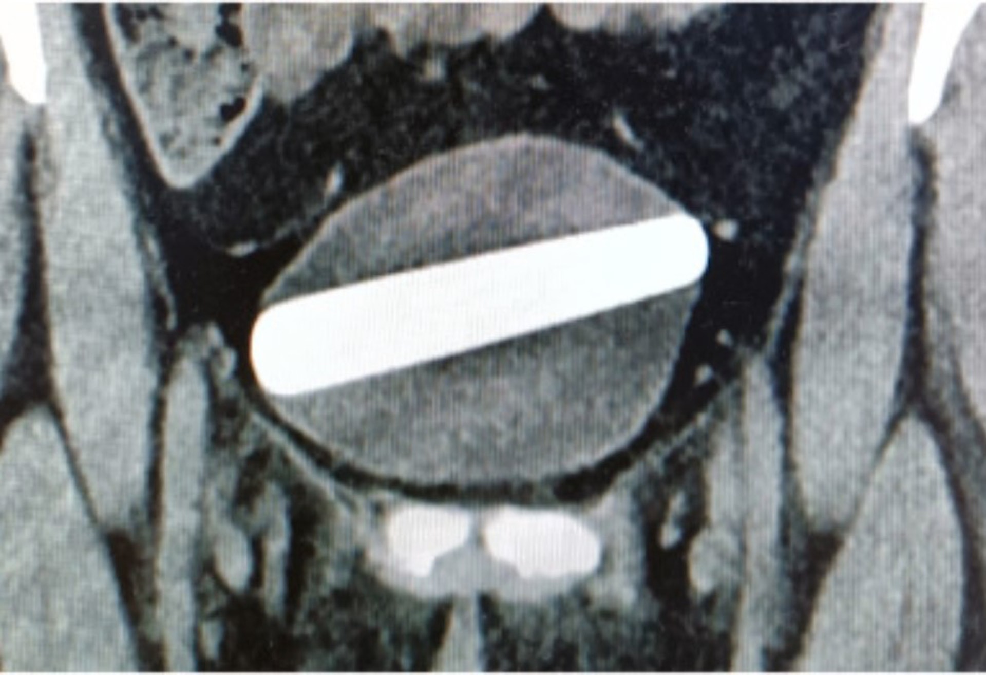 以色列1名29歲女子誤將水晶假陽具塞入尿道,假陽具水平地卡在膀胱內,她嘗試取出不果,於是前往醫院求診。(《泌尿外科病例報告》圖片)