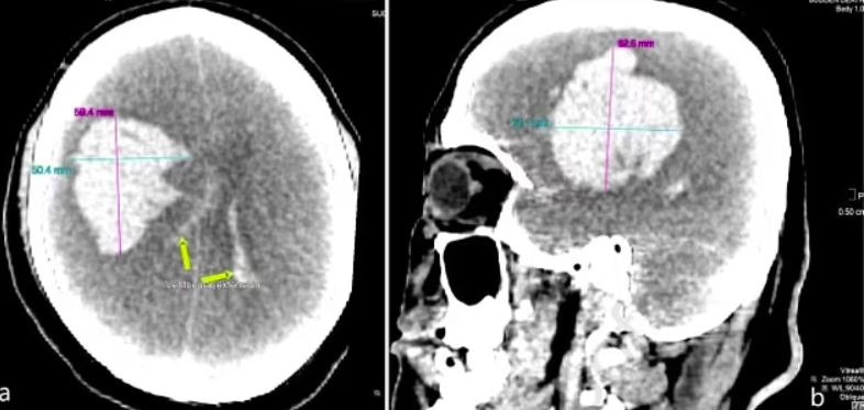 驗屍結果顯示,男子腦血管破裂出血,還有300克血塊。(網上圖片)
